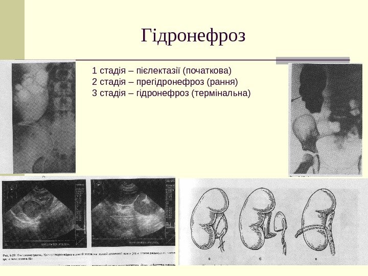   Гідронефроз 1 стадія – пієлектазії (початкова) 2 стадія – прегідронефроз (рання) 3